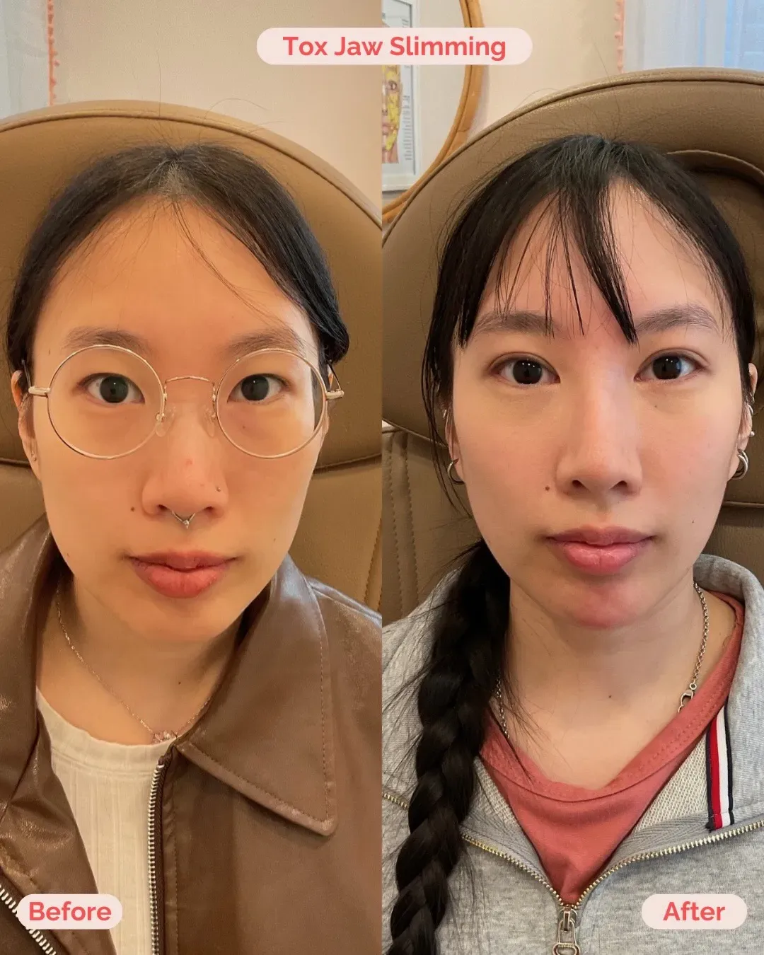 B&A 2025- masseter_min