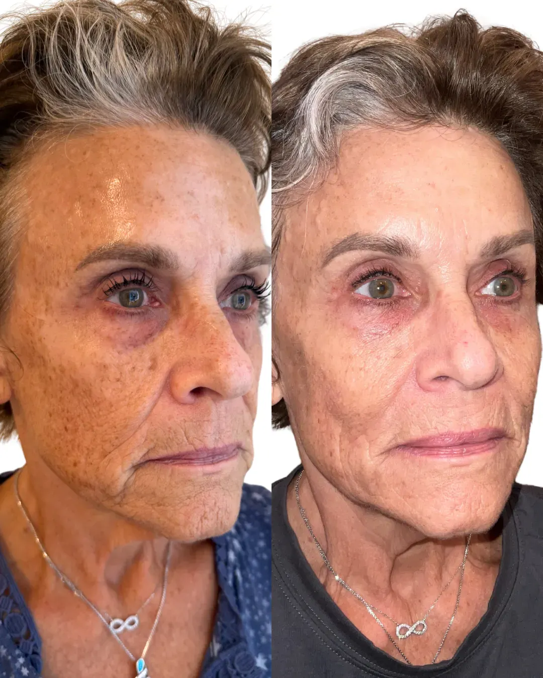 Skin Resurfacing Richmond VA