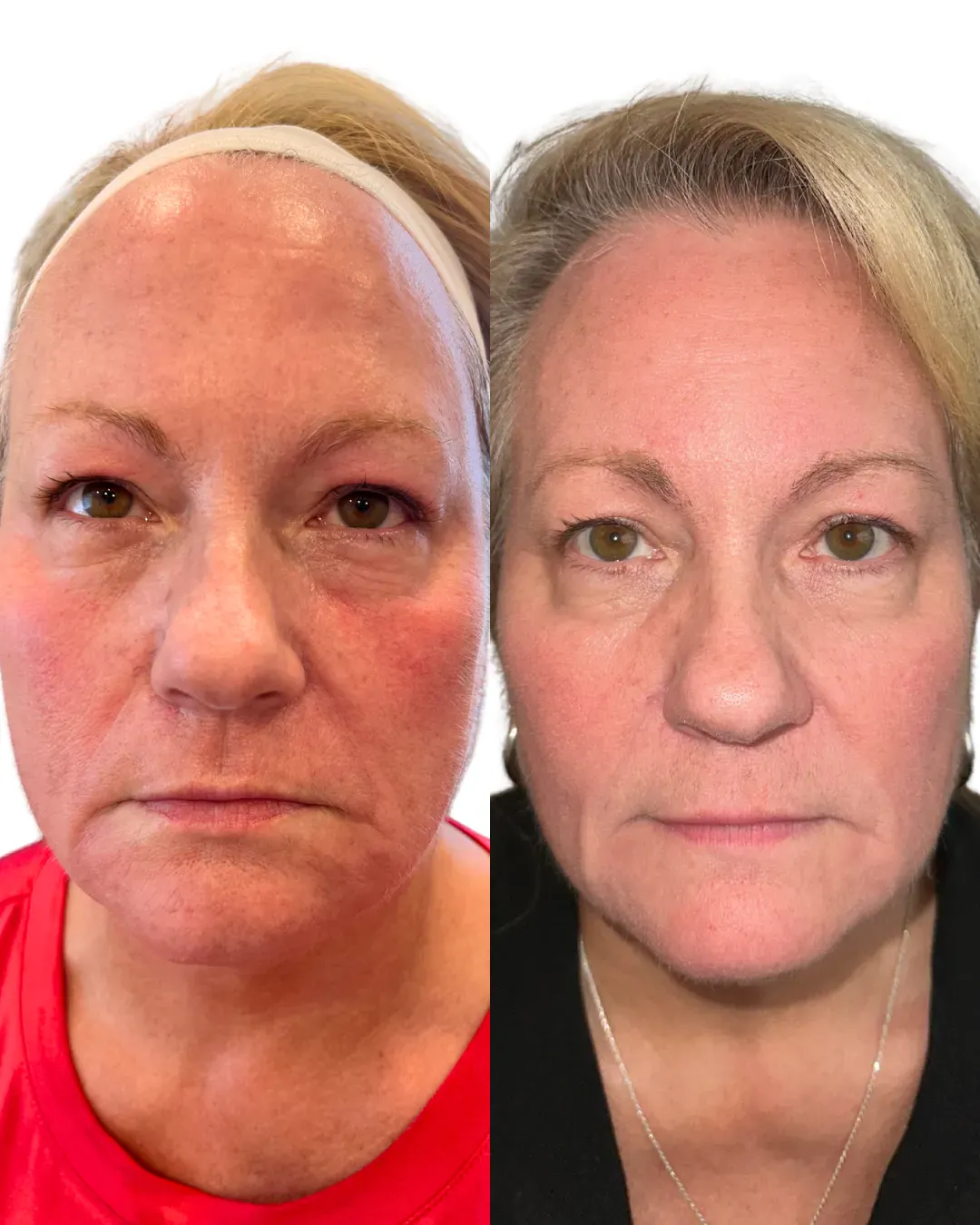 Skin Resurfacing Richmond VA