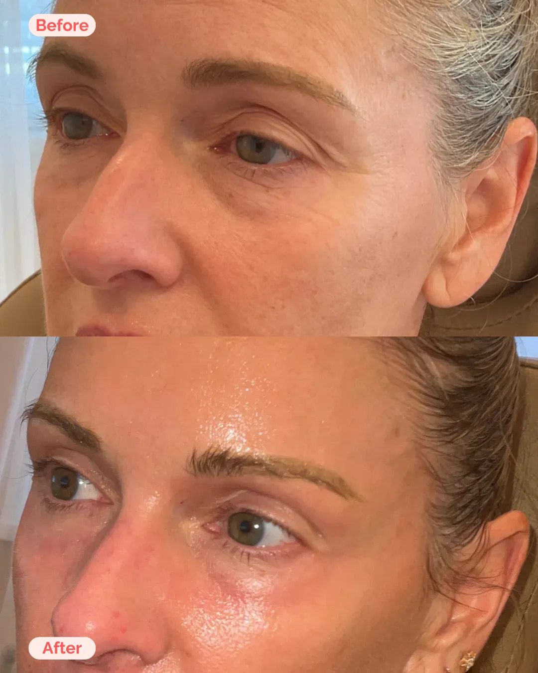 Skin Resurfacing Richmond VA