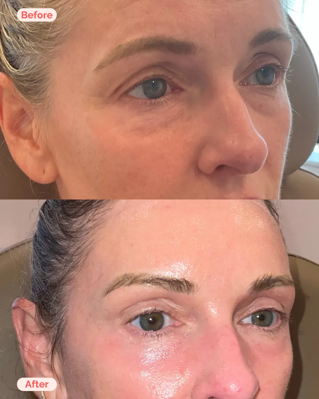 Skin Resurfacing Richmond VA