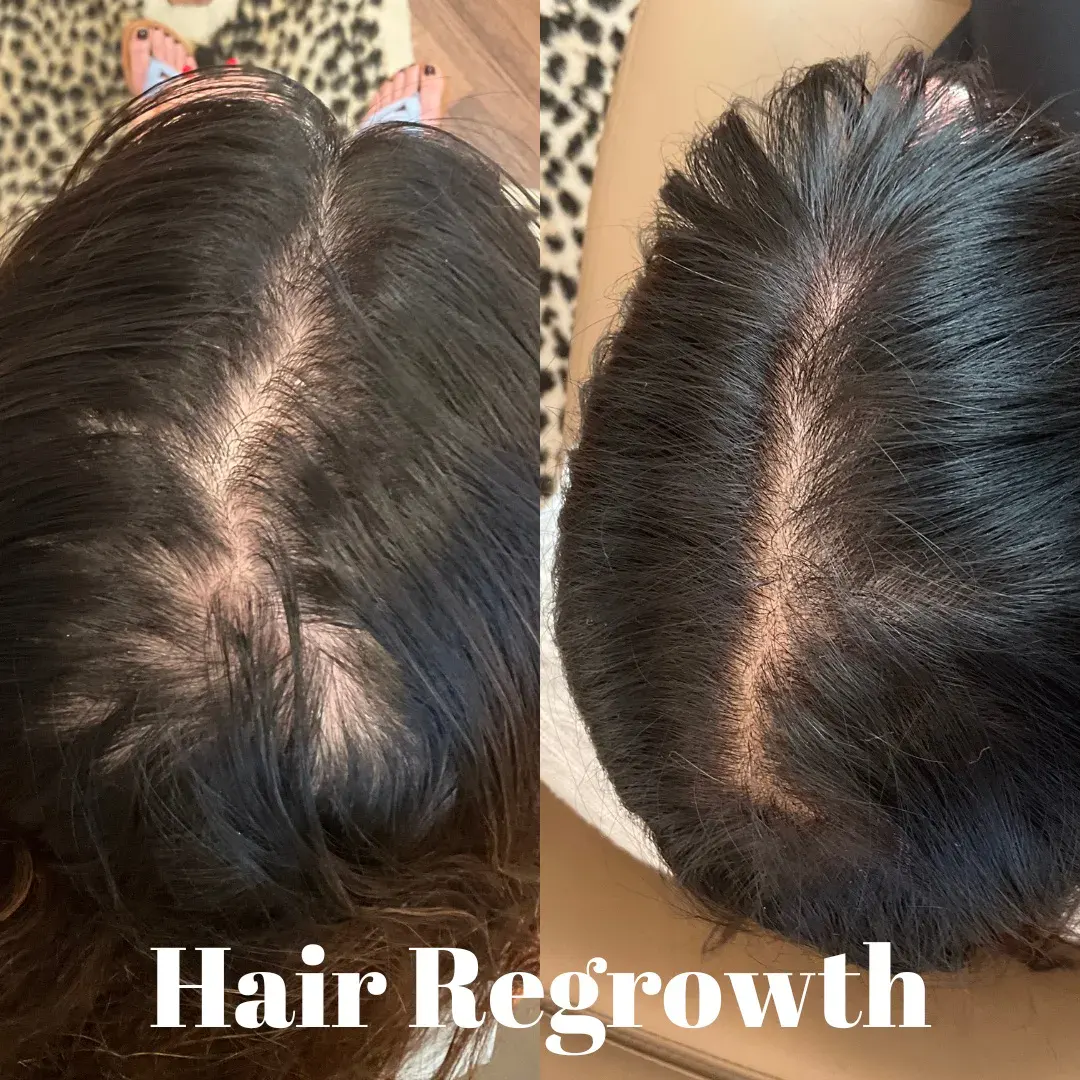 Hair Regrowth Treatment Richmond VA