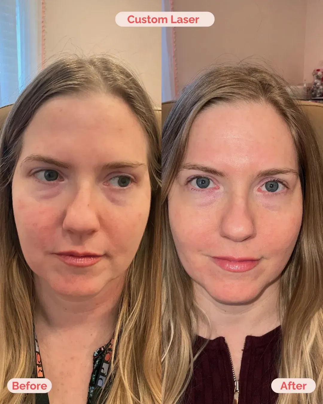 Laser Treatment Richmond VA