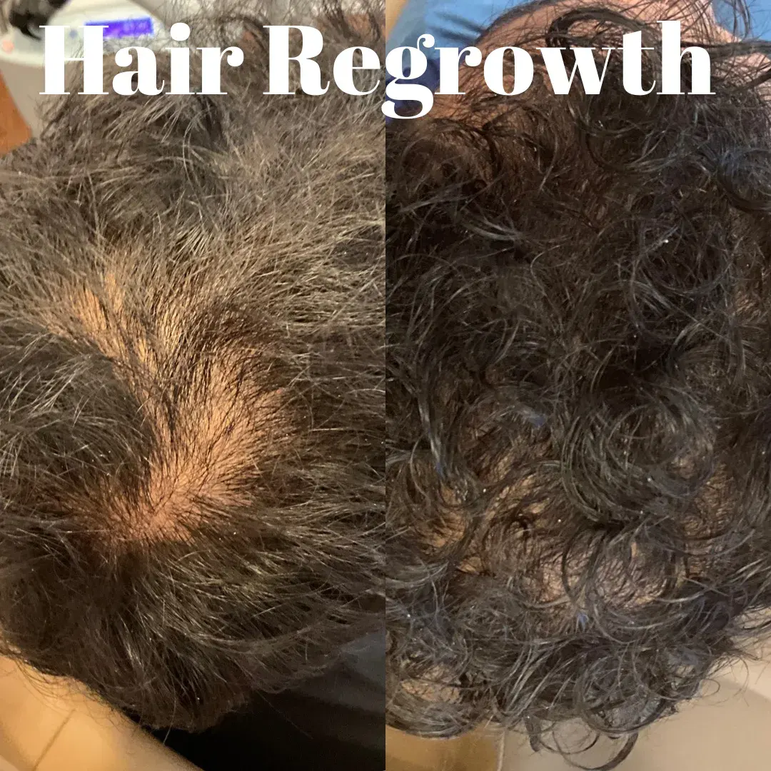 Hair Regrowth Treatment Richmond VA