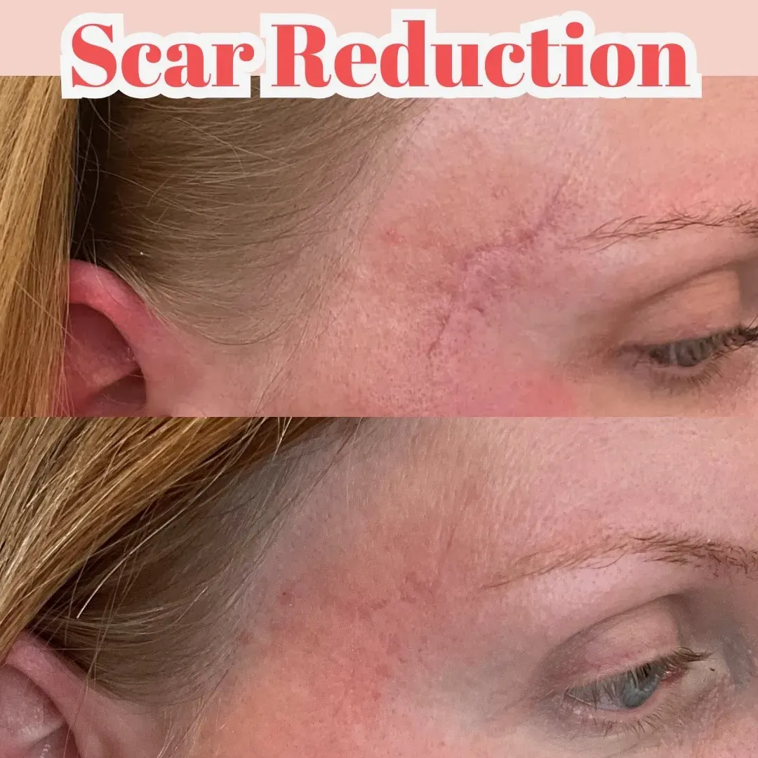 Laser Treatment Richmond VA