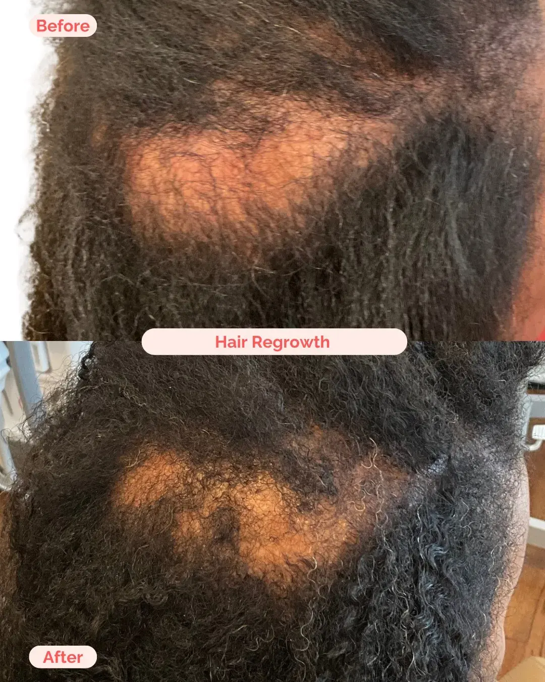 Hair Regrowth Treatment Richmond VA
