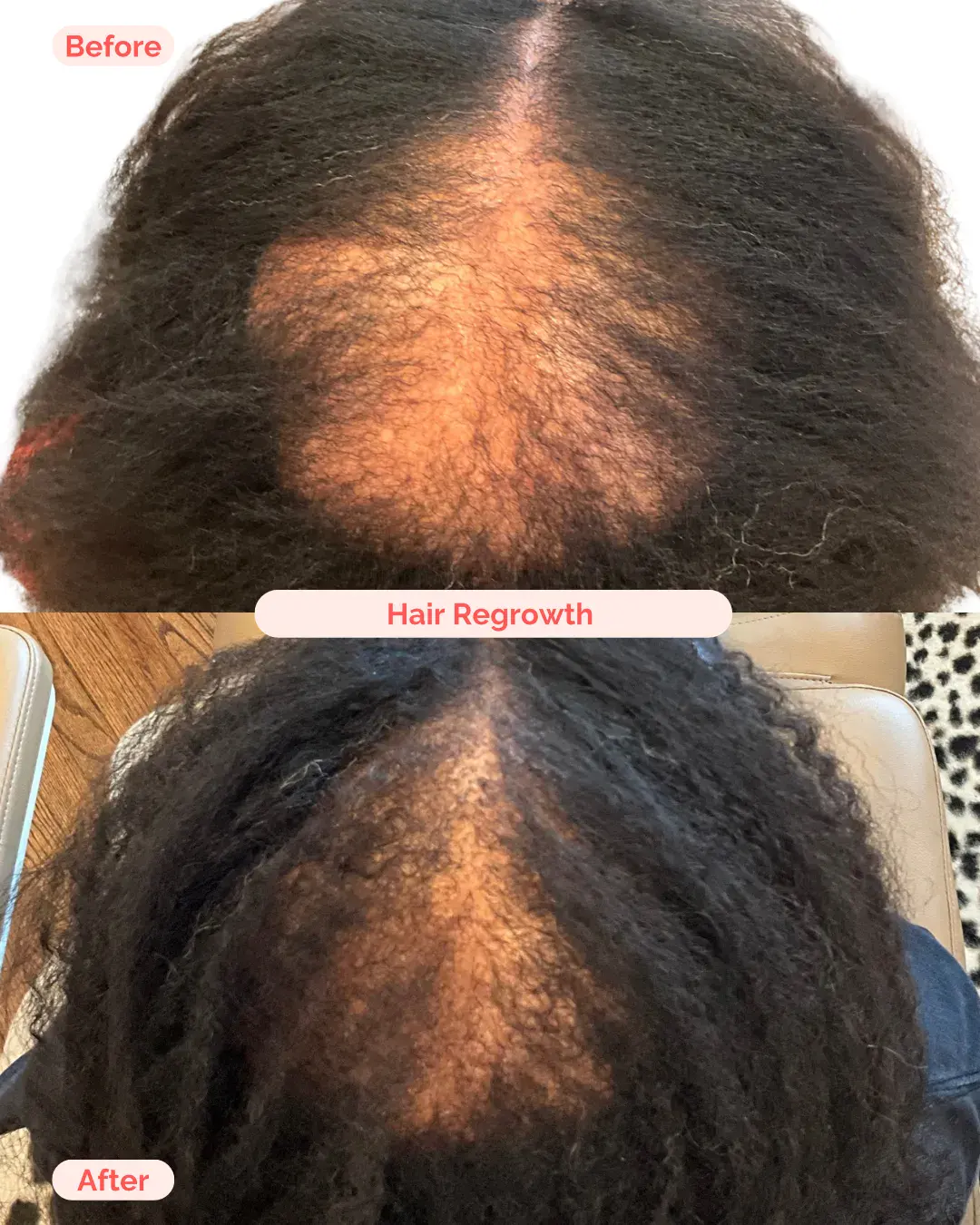 Hair Regrowth Treatment Richmond VA