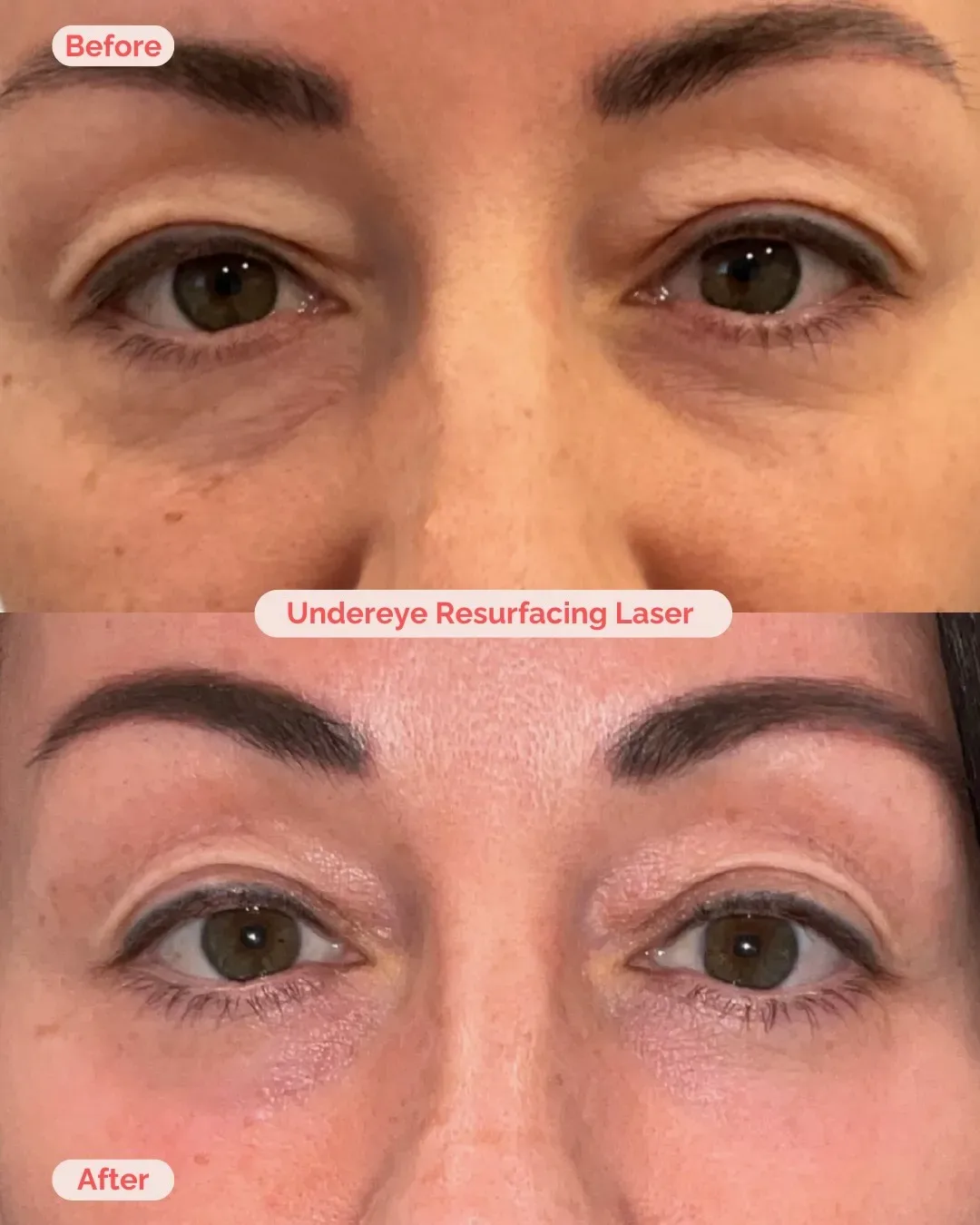 Laser Treatment Richmond VA