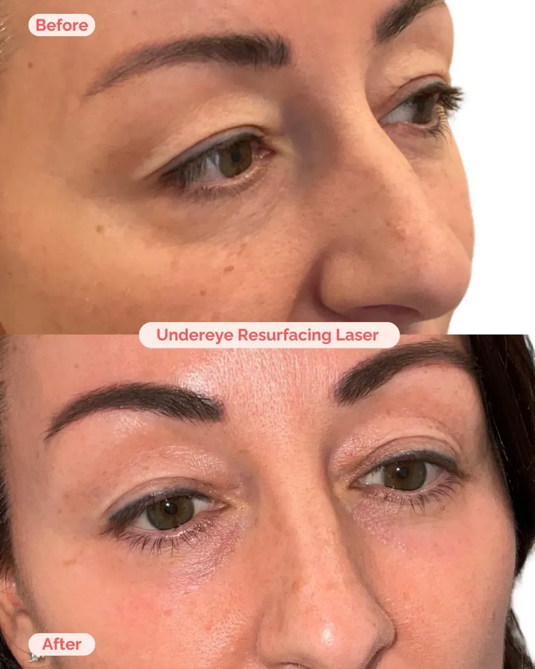 Laser Treatment Richmond VA