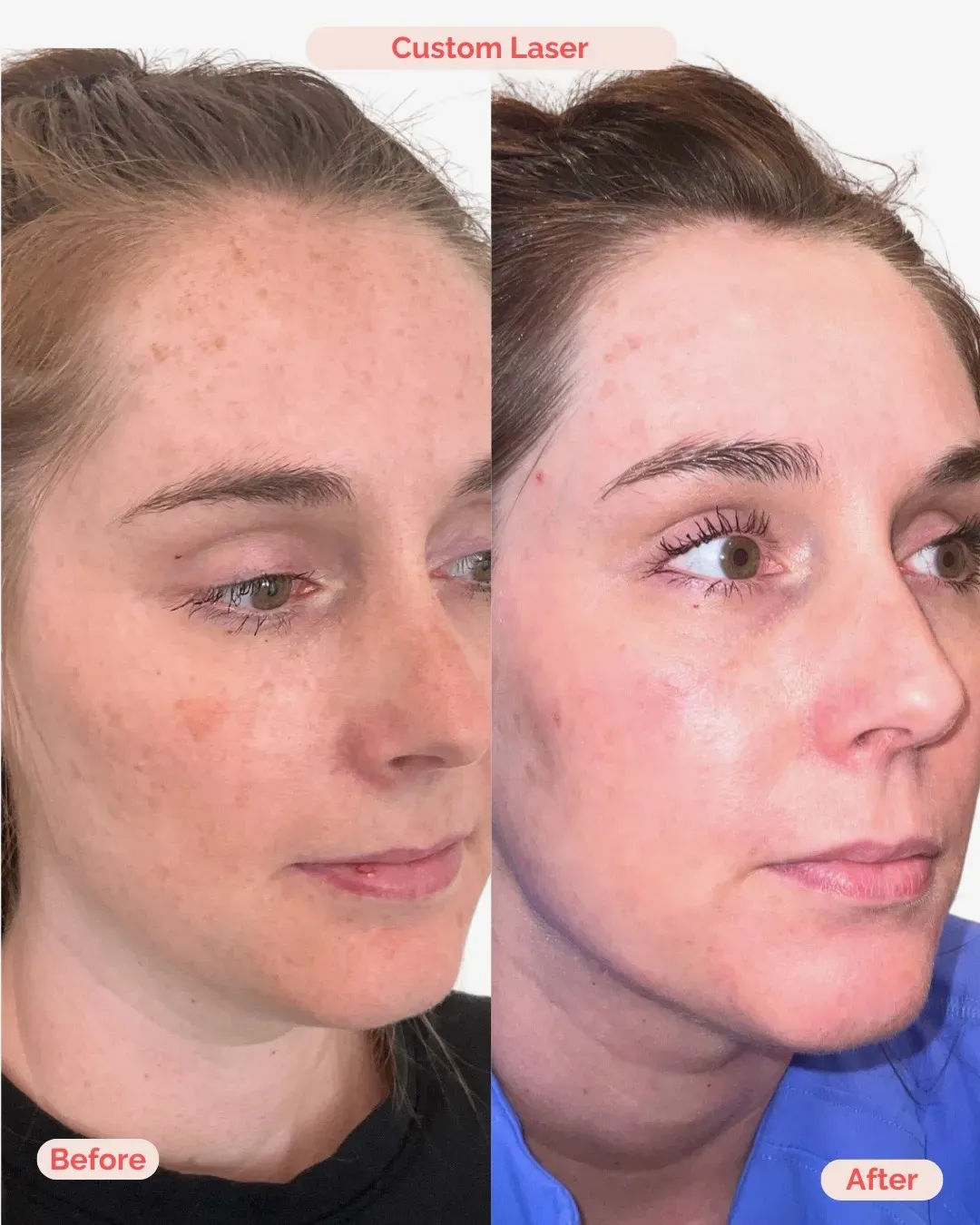 Laser Treatment Richmond VA