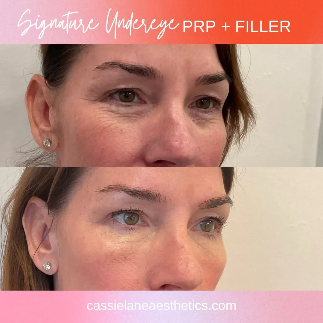 undereye prp website_min